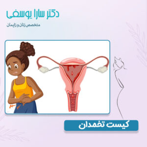 کیست تخمدان - دکتر سارا یوسفی