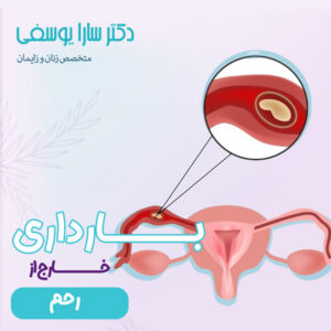 بارداری خارج از رحم - دکتر یوسفی