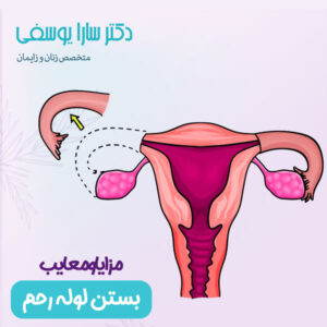 بستن لوله های رحمی - دکتر سارا یوسفی