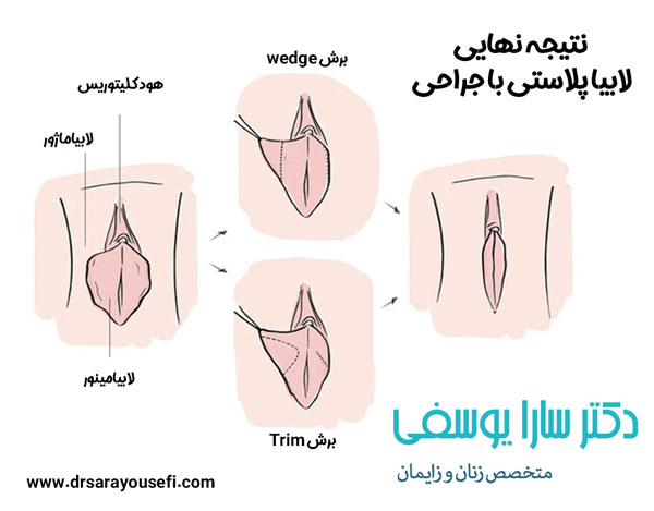 لابیاپلاستی - دکتر یوسفی