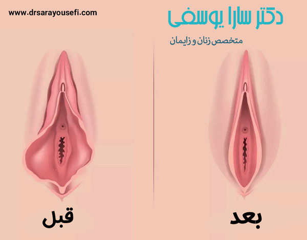 عکس قبل و بعد از لابیاپلاستی - دکتر یوسفی