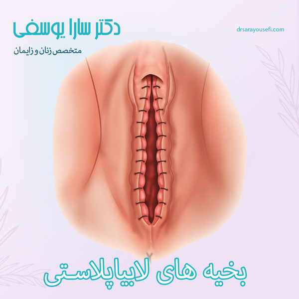 بخیه های لابیاپلاستی https://drsarayousefi.com/