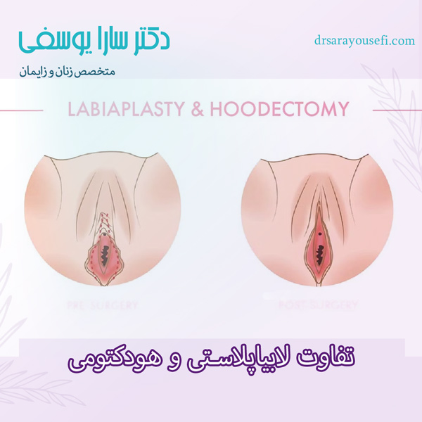 تفاوت لابیاپلاستی و هودکتومی https://drsarayousefi.com/