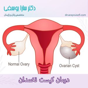 درمان کیست تخمدان https://drsarayousefi.com/