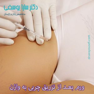 ورم بعد از تزریق چربی به واژن https://drsarayousefi.com/
