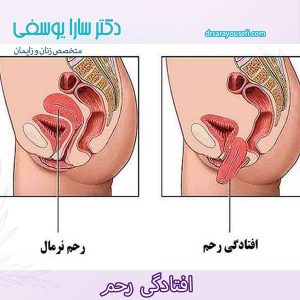 افتادگی رحم