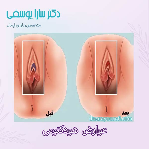 عوارض هودکتومی _ دکتر سارا یوسفی