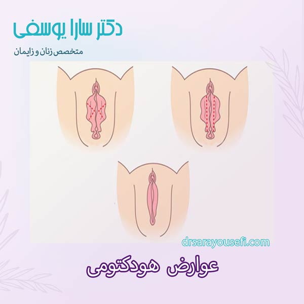 عوارض هودکتومی _ دکتر سارا یوسفی
