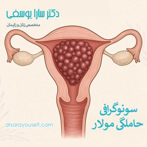 سونوگرافی حاملگی مولار _ دکتر سارا یوسفی