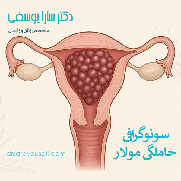 سونوگرافی حاملگی مولار _ دکتر سارا یوسفی