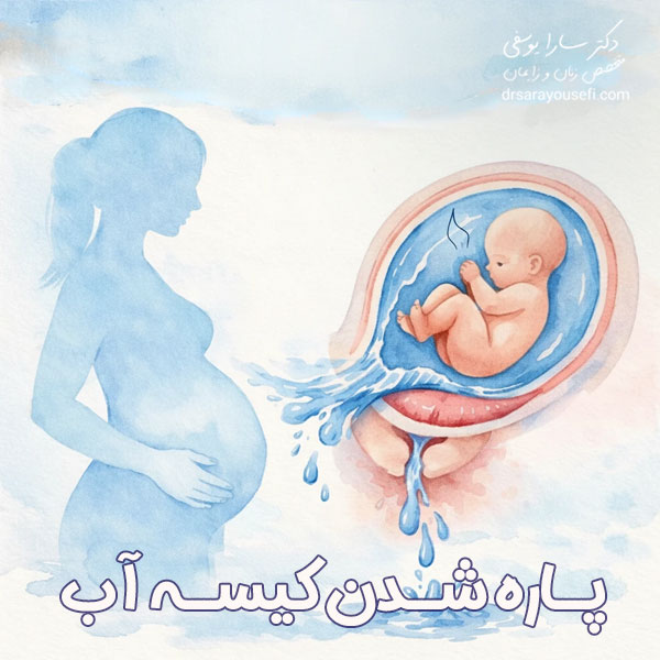 پاره شدن کیسه آب + دکتر سارا یوسفی